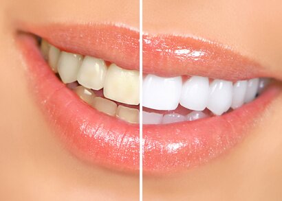 Результаты до и после отбеливания зубов